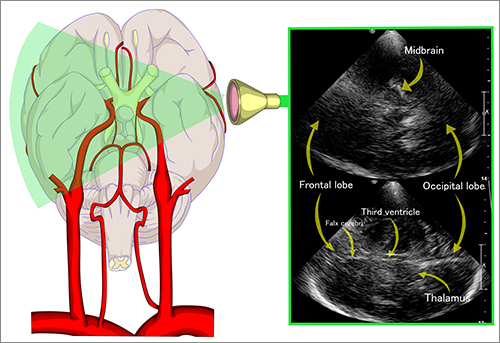 Illustration shown the transcranial Doppler sonography on the left temporal window. The imaging shown the organs in the brain on both right and left hemispheres.