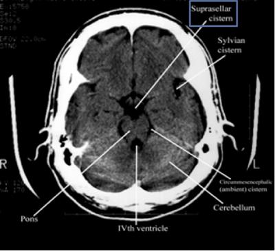 CT scan of brain
