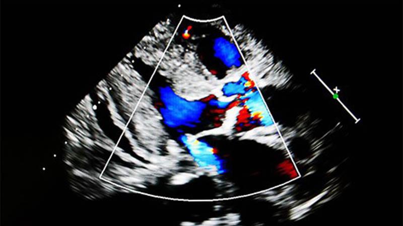 Ultrasound flow color mode show jet from aortic and mitral valve regurgitation