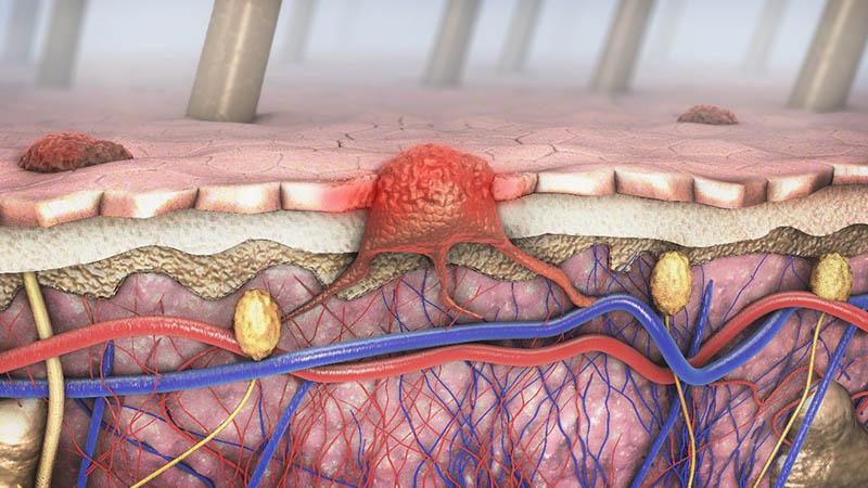 Cross-section of a diseased skin with melanoma that enters the bloodstream and lymphatic tract