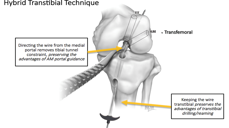 Pursuing Novel Techniques for ACL Reconstruction