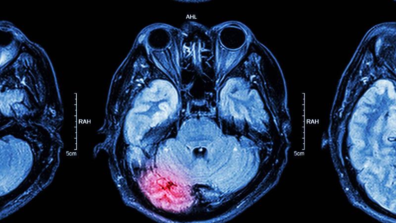 MRI of brain: brain injury