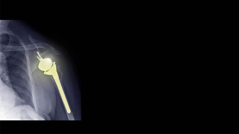 Total Shoulder Arthroplasty: Guidelines for Discussing Patient Expectations
