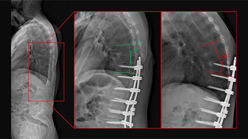 Radiology images of a patient with PJK. (Left) baseline (no hardware), (middle) immediate postoperative image (no PJK), and (right) 2.5 years follow-up image (PJK)
