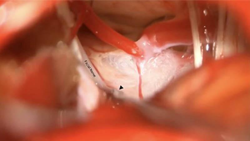 Facial nerve massage for treatment of hemifacial spasm refractory to MVD; arrowhead points to the dissector used to massage the facial nerve.