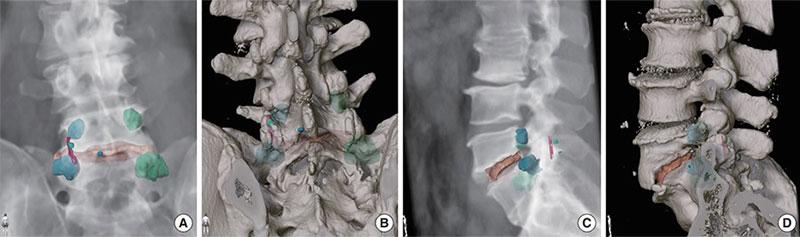 Landmarks for a L5/S1 transforaminal lumbar interbody fusion via left sided surgical approach highlighted on a CT 3D reconstruction posterior view (A, B) and left sided lateral view (C, D). (Credit: Neurospine, September 2022)