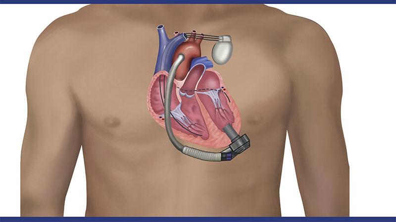 LVAD: A Change of Pace for CRT