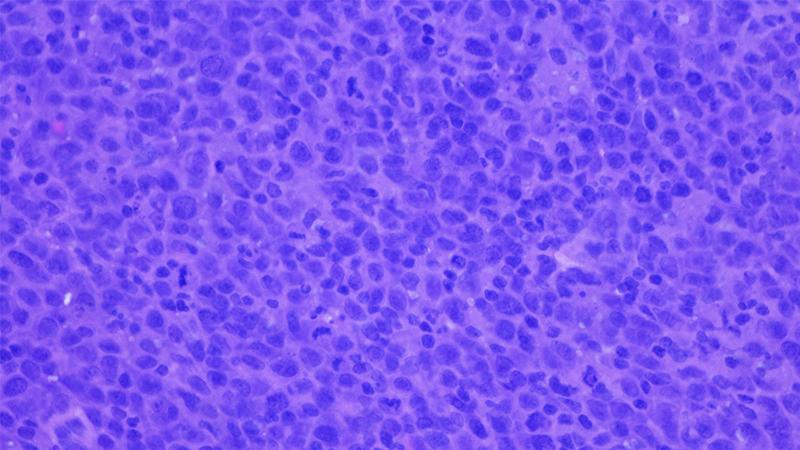 Breakthroughs in B-Cell Cancers