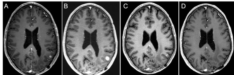 Magnetic resonance contrast-enhanced axial T1 images taken throughout the course of treatment for a 36-year-old man with IDH wild-type MGMT promoter methylated GBM