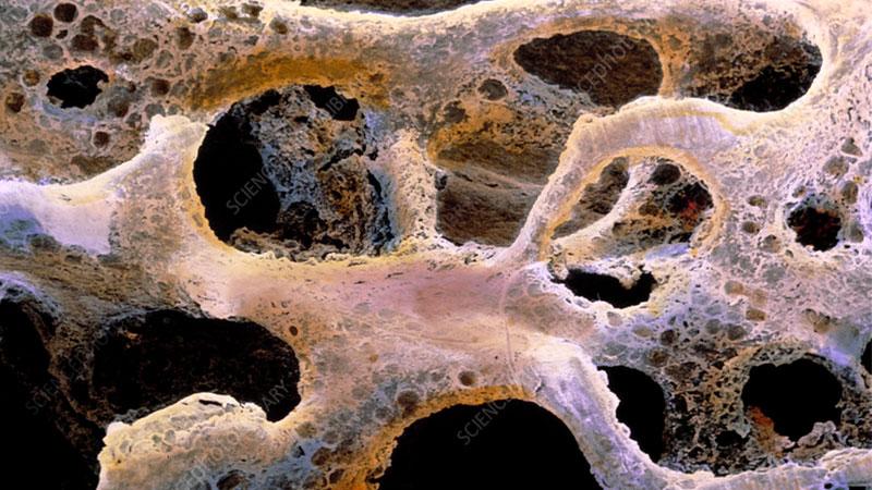 Managing Osteoporosis in the Setting of Spinal Reconstruction