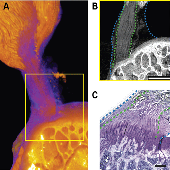 Augmenting Repair Where the Tendon Meets the Bone