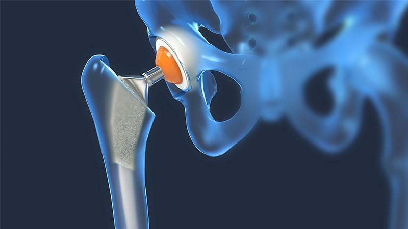 close-up of joint replacement