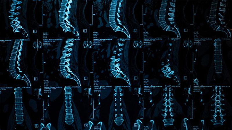 Robotic Spine Surgery: Weighing the Benefits