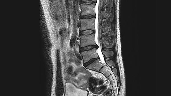 MRI of the spine showing one herniated disc that is pressing on the spinal cord