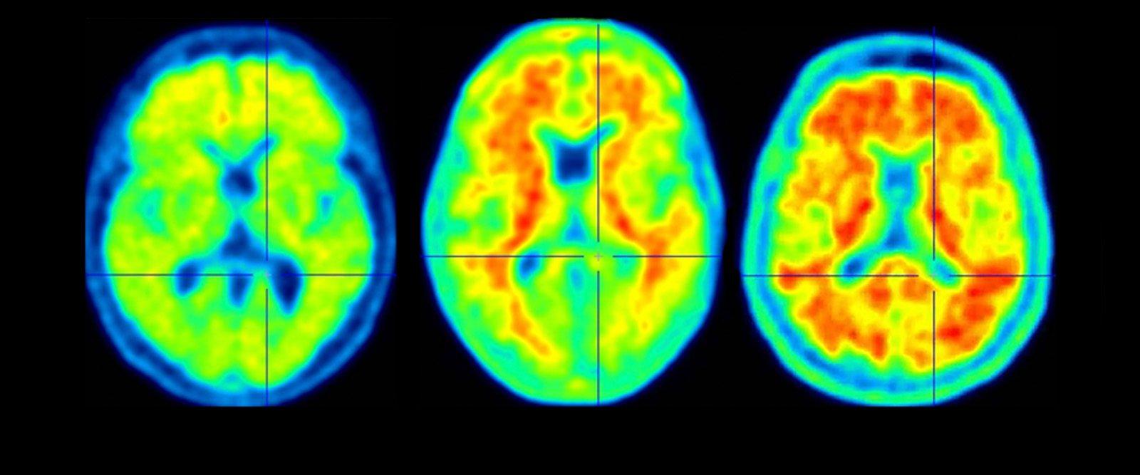 What to Know About New Alzheimer's Disease Treatments | Health Matters
