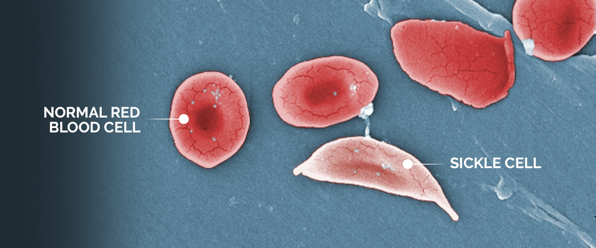 What to Know About Sickle Cell Disease