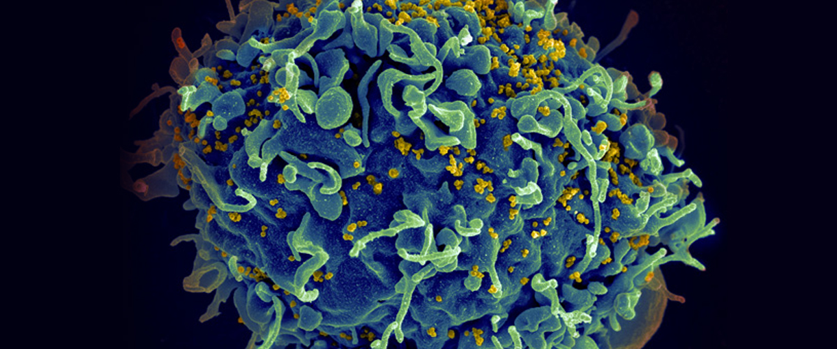 Patient With HIV Appears to Have Been Cured by Umbilical Cord Blood Transplant