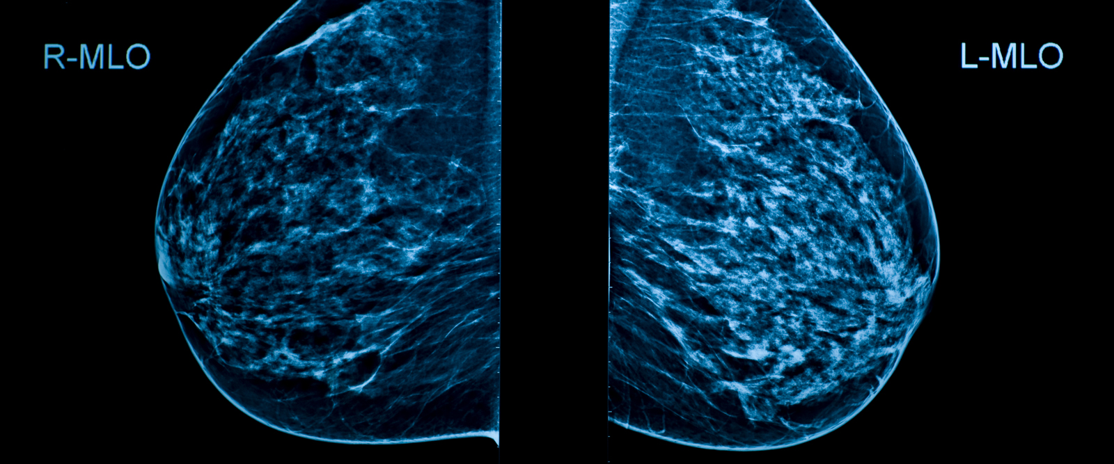 Breast Density Information to Become a Regular Part of Mammogram Results, the FDA Announces