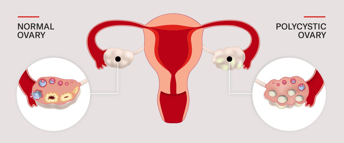 Pocs Polycystic Ovary Syndrome What Is It And How Do You Treat Pcos 330x221