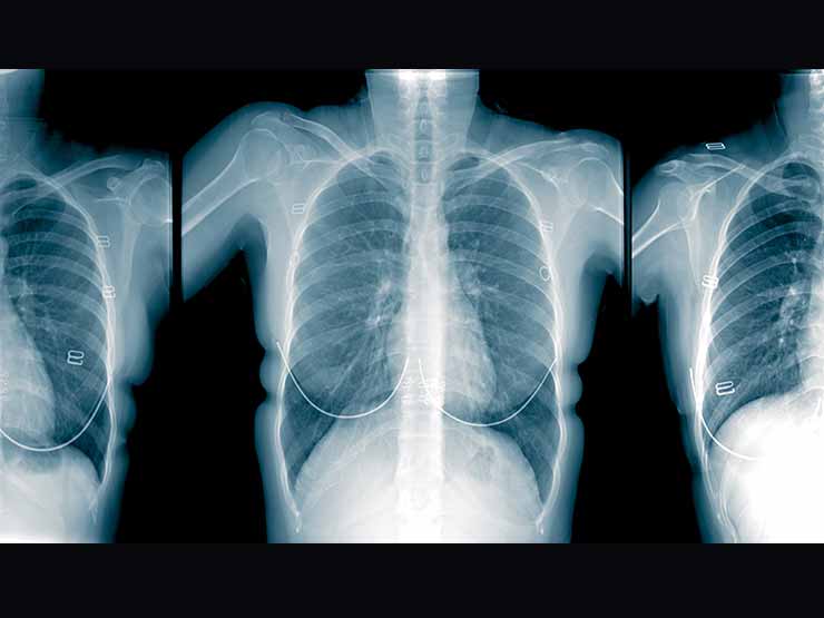 xrays of the lungs
